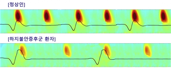 수면뇌파 시간-주파수 분석 external image(위쪽 붉은색 덩어리 부분이 수면방추, 아래쪽 선에서 나타난 굴곡이 느린진동. 정상인은 1분 동안 평균 수면방추 6회, 느린진동 3회가 나타나는 것에 비해 하지불안증후군 환자는 각각 4회, 2회에 그친다. 또한 수면방추의 활성화도 옅고 느린진동의 최고점에서 만나는 연결성도 떨어진다. 사진제공 : 서울대병원)