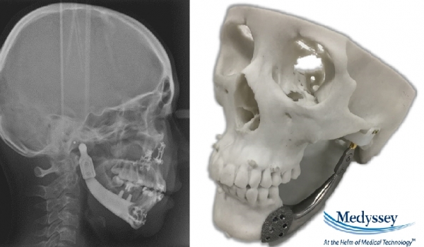 3D프린팅으로 제조된 환자맞춤형 인공 하악골 사진(왼쪽), 3D프린팅으로 제조된 환자맞춤형 인공 하악골 X레이 사진(오른쪽)