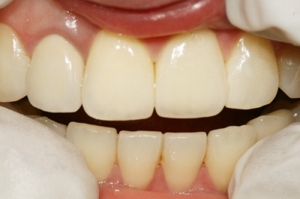 치아성형, 자연치아손상 최소화에 중점 둬야